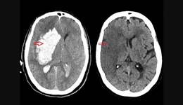 Brasil perde uma vida a cada seis minutos por AVC, mas maioria dos casos é evitável