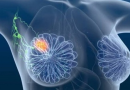 Tratamento inovador elimina totalmente o câncer de mama em estágio inicial