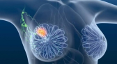 Tratamento inovador elimina totalmente o câncer de mama em estágio inicial